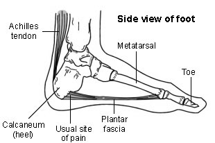 Heel and Foot Pain (Plantar Fasciitis)