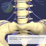 Sciatica; What is it? How we can help?
